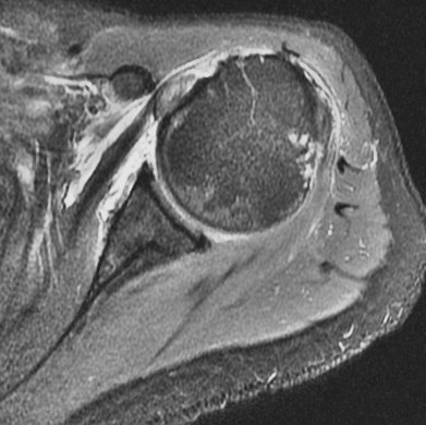Figure 5 for case HAGL lesion and rotator cuff tears